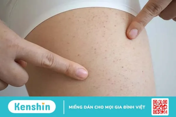 Giải đáp nhanh 5 băn khoăn phổ biến về giảm tiểu cầu miễn dịch