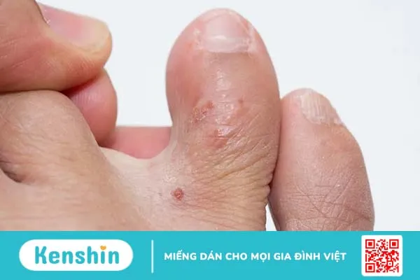 Giải đáp thắc mắc: Bệnh tổ đỉa có lây không?