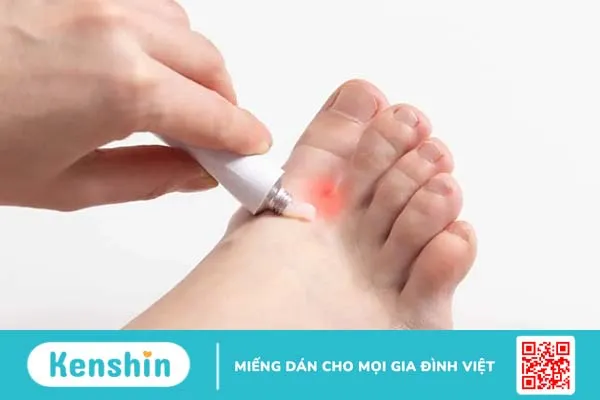 Giải đáp thắc mắc: Bệnh tổ đỉa có lây không?