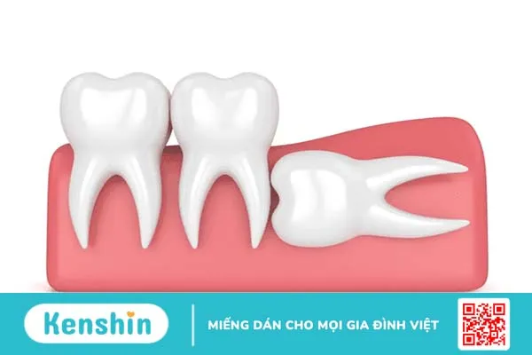 Giải đáp thắc mắc: Đau nhức răng báo hiệu điều gì, cách điều trị hiệu quả