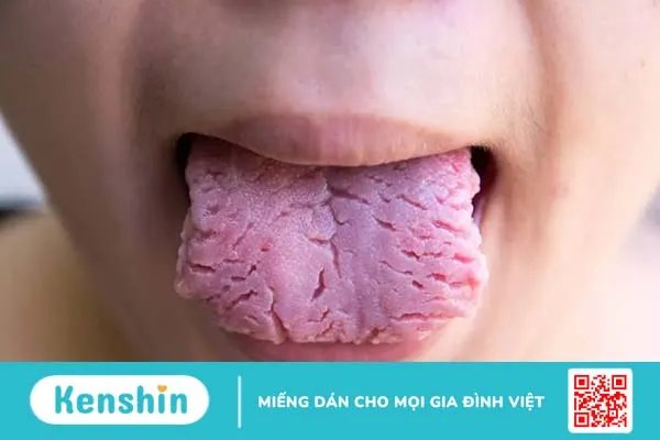 Giải đáp thắc mắc: Lưỡi bị nứt là bệnh gì, có cần điều trị hay không?