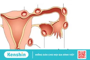 Giải đáp thắc mắc: Thắt ống dẫn trứng vẫn có thai là do đâu?