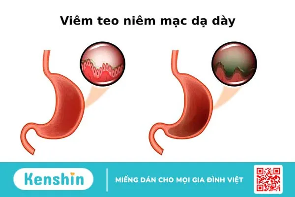 Giải đáp: Viêm teo niêm mạc dạ dày có trở thành ung thư không?