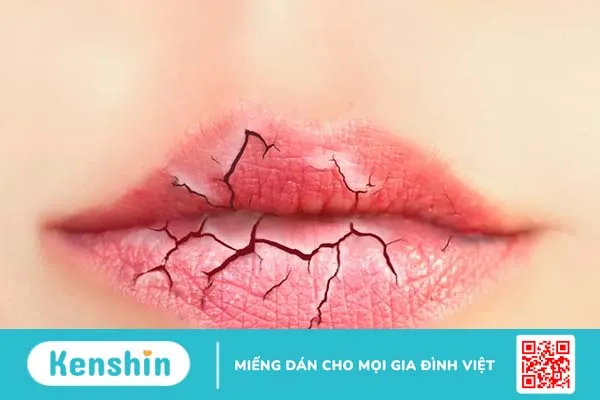 Giảm tiết mồ hôi: Nguyên nhân, triệu chứng, cách điều trị