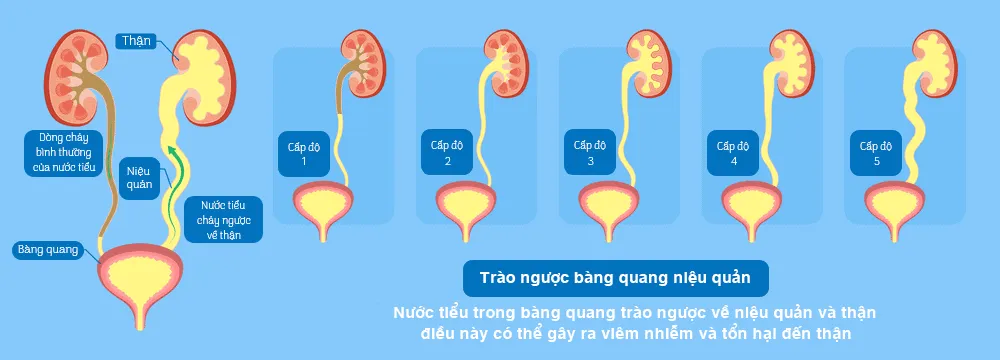 Giãn đài bể thận ở thai nhi có nguy hiểm không? Những điều mẹ cần biết