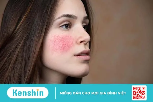 Giãn mao mạch có điều trị dứt điểm được không?