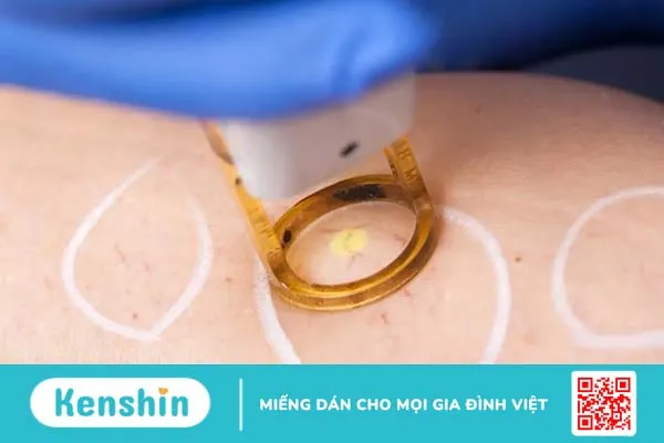 Giãn mao mạch có điều trị dứt điểm được không?