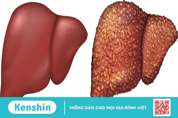 Giãn tĩnh mạch thực quản