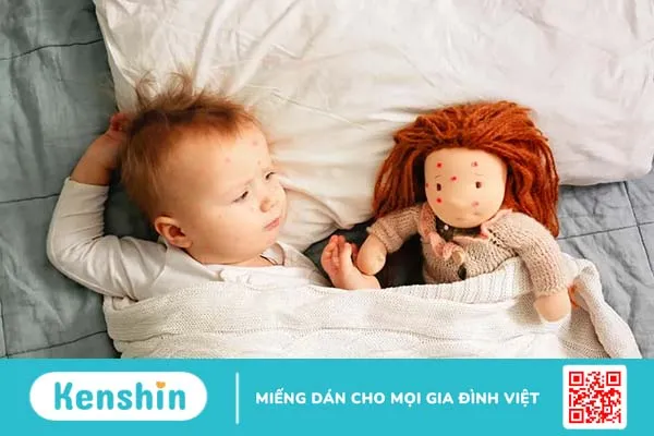 “Giật mình” với các biến chứng thủy đậu ở trẻ em