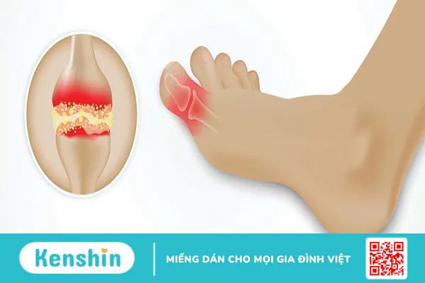 Gout cấp có nguy hiểm không? Những ai có nguy cơ cao mắc bệnh này?