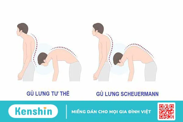 Gù lưng trẻ em: Nguyên nhân, dấu hiệu, điều trị và phòng ngừa