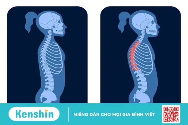 Gù lưng trẻ em: Nguyên nhân, dấu hiệu, điều trị và phòng ngừa