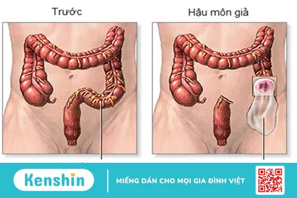 Hậu môn nhân tạo: Những điều quan trọng bạn cần biết