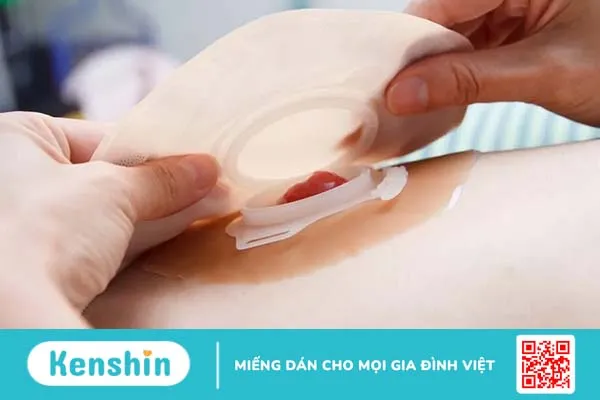 Hậu môn nhân tạo: Những điều quan trọng bạn cần biết