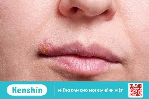 Herpes môi có nguy hiểm không? Cách điều trị herpes môi