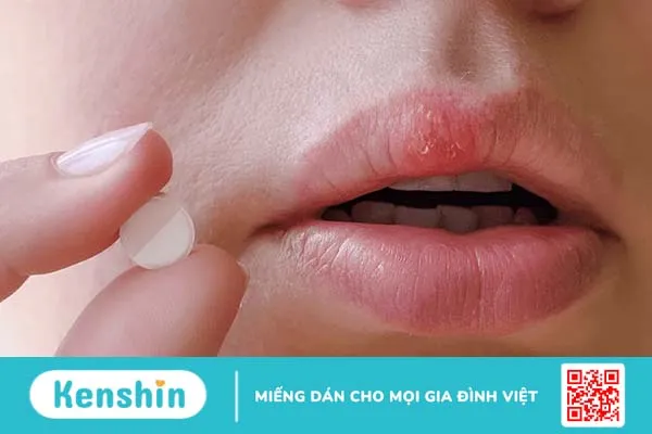 Herpes môi có nguy hiểm không? Cách điều trị herpes môi