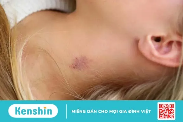 Hickey là gì? Cách Hickey trên cơ thể người yêu