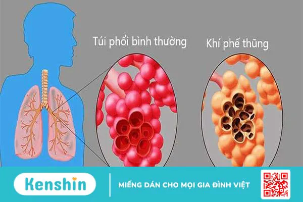 Hiểu về bệnh khí phế thũng giúp điều trị hiệu quả