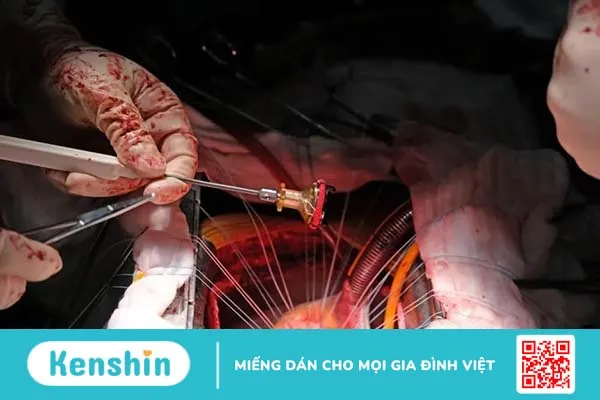 Hở van động mạch chủ