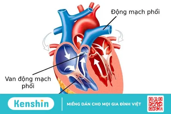 Hở van động mạch phổi