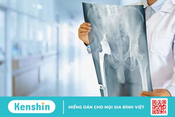 Hoại tử chỏm xương đùi: Căn bệnh phát triển thầm lặng!