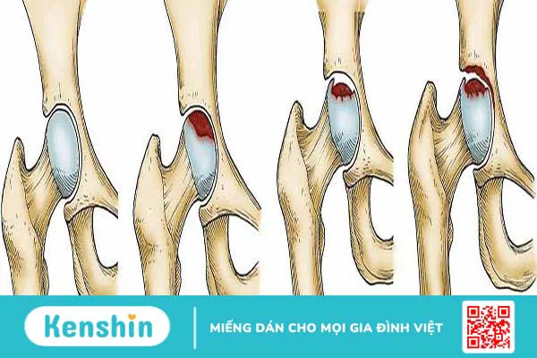 Hoại tử chỏm xương đùi: Căn bệnh phát triển thầm lặng!