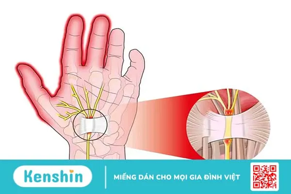 Hội chứng chèn ép dây thần kinh