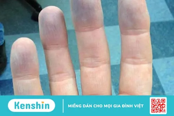 Hội chứng xanh tím da