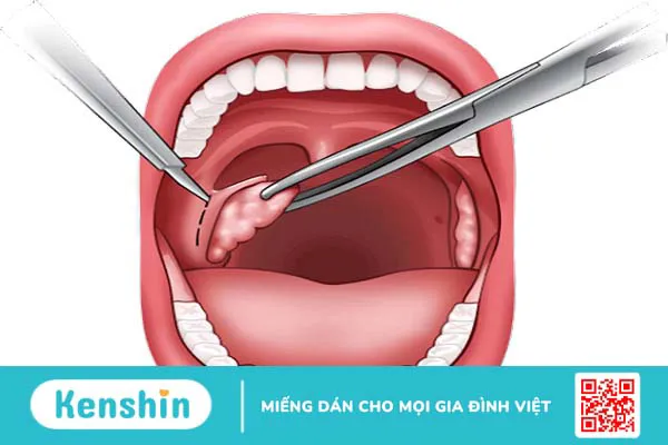 Hỏi đáp bác sĩ: Cắt amidan có ảnh hưởng gì không?