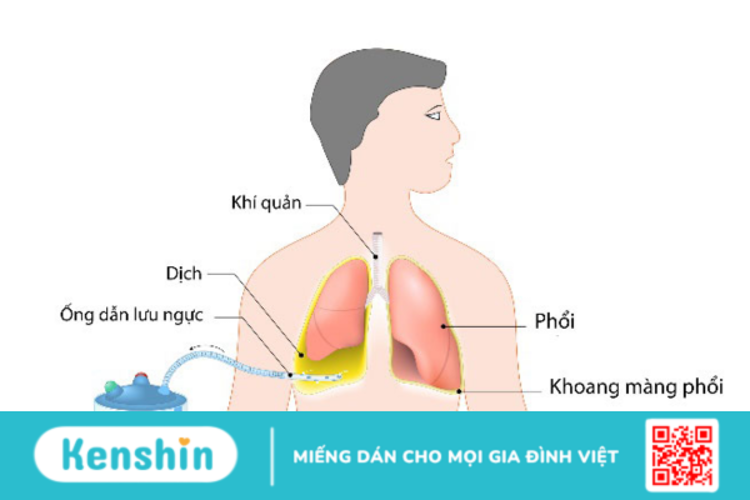 Hỏi đáp bác sĩ: Điều trị tràn dịch màng phổi bao lâu?