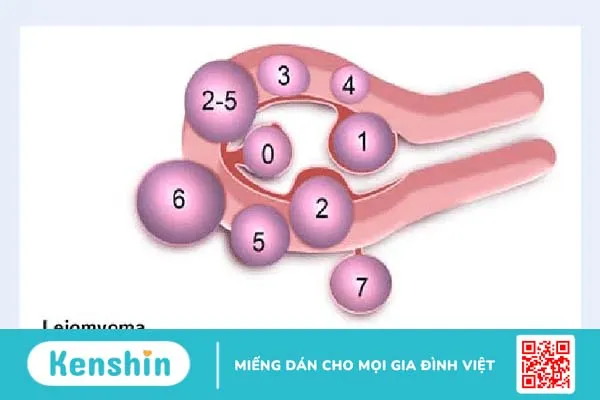 Hỏi đáp Bác sĩ: Nhân xơ tử cung loại 4 là gì, có chữa khỏi được không?