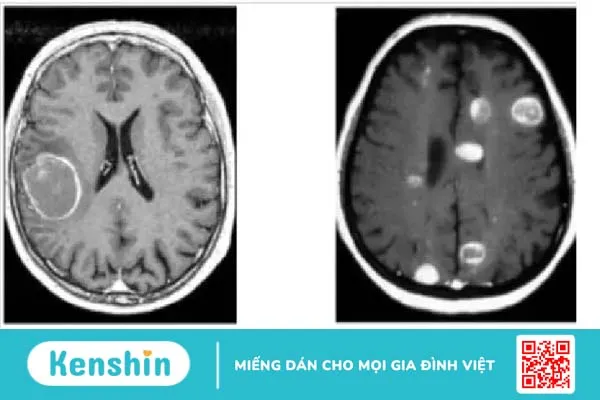 Hỏi đáp bác sĩ: Ung thư di căn lên não sống được bao lâu?