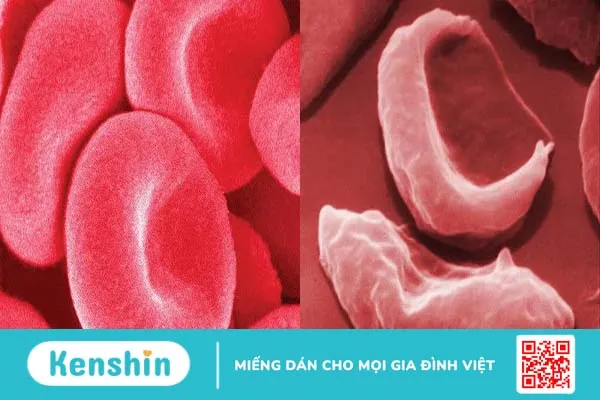 Hồng cầu lưỡi liềm