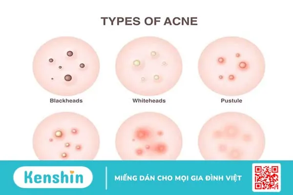 Hướng dẫn các bước skincare cho da mụn