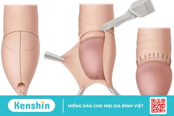 Hướng dẫn cách chăm sóc và điều trị sẹo sau khi cắt bao quy đầu