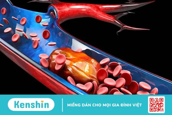 Huyết khối tĩnh mạch sâu chi dưới