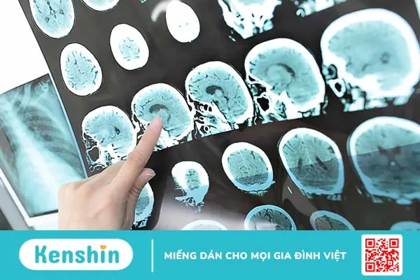 Khám phá căn bệnh hiếm gặp: Viêm não tự miễn