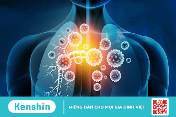 Khi nào dùng kháng sinh điều trị viêm phế quản? Lưu ý gì khi dùng?