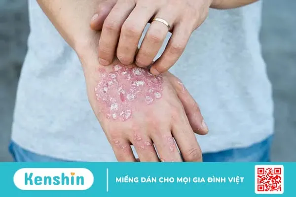 Lạm dụng corticoid trong điều trị vảy nến gây nguy hiểm khôn lường