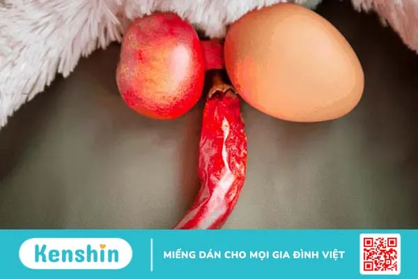 Làm rõ mối liên hệ giữa giãn tĩnh mạch thừng tinh với vô sinh