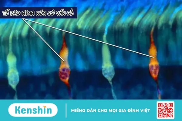 Làm thế nào để kiểm tra mù màu? Nguyên nhân và cách nhận biết bệnh