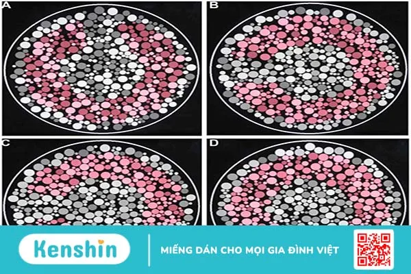 Làm thế nào để kiểm tra mù màu? Nguyên nhân và cách nhận biết bệnh