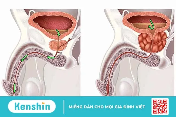 Làm thế nào điều trị phì đại tuyến tiền liệt hiệu quả?