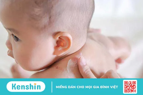 Lang ben ở trẻ sơ sinh có nguy hiểm không? Chữa trị như thế nào?