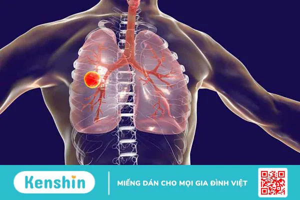 Lao kháng thuốc là gì? Triệu chứng, chẩn đoán và điều trị ra sao?