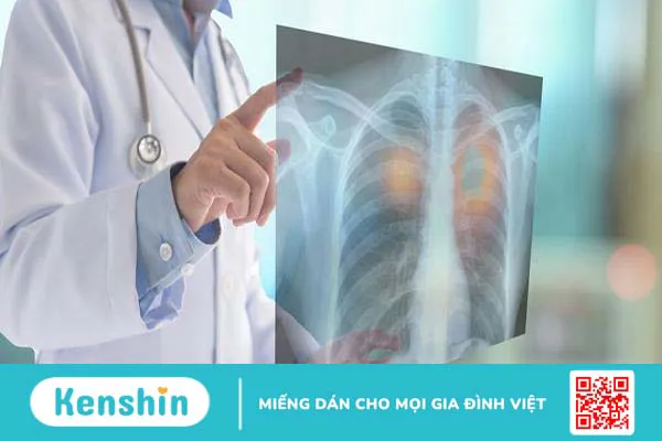 Lao ruột là gì? Những điều cần biết về căn bệnh lao ruột