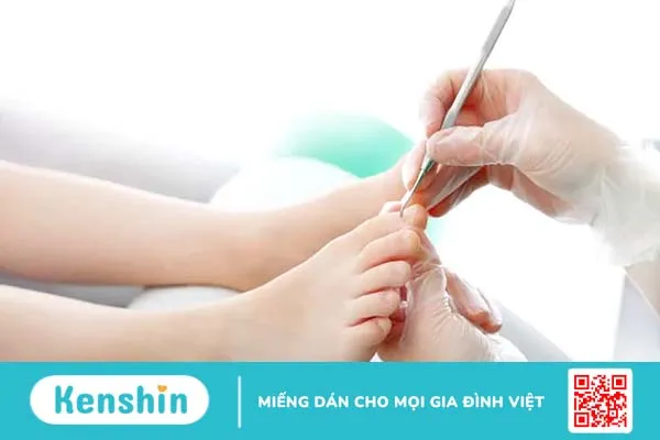 Lấy khóe móng chân bị sưng mủ phải làm sao?