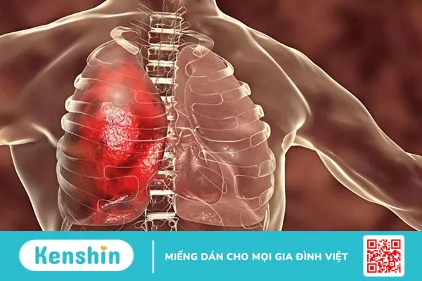 Liên cầu khuẩn nhóm B là gì? Nguyên nhân, dấu hiệu, điều trị, phòng ngừa