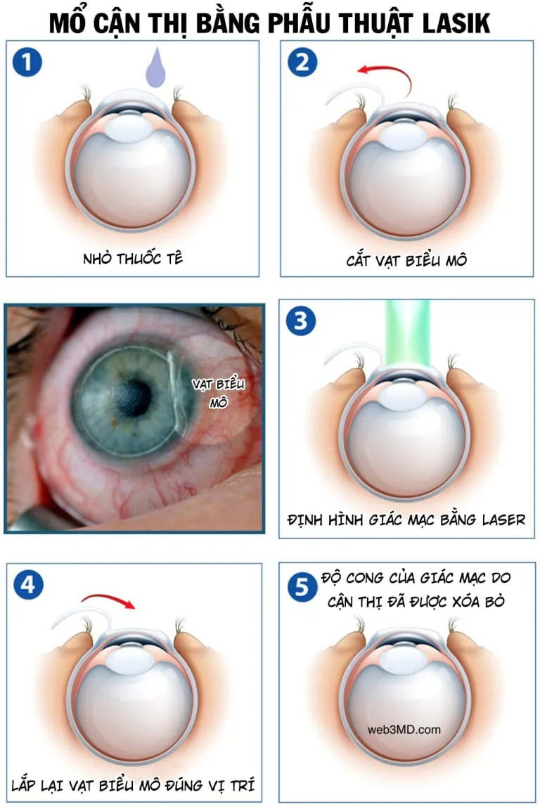 Liệu bạn có đủ điều kiện để mổ cận thị?