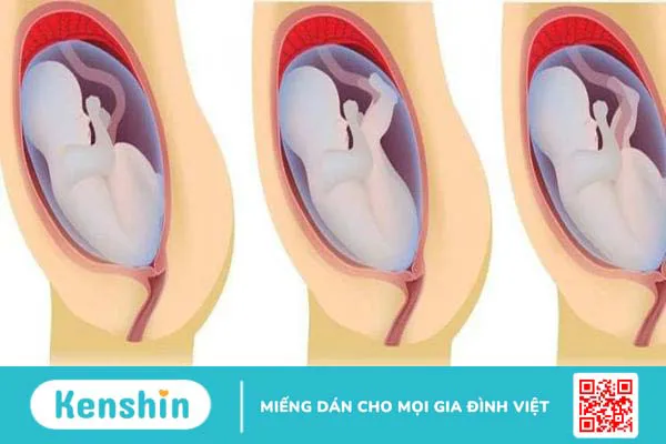 Loạn sản khớp háng:Những điều bạn cần nên biết!